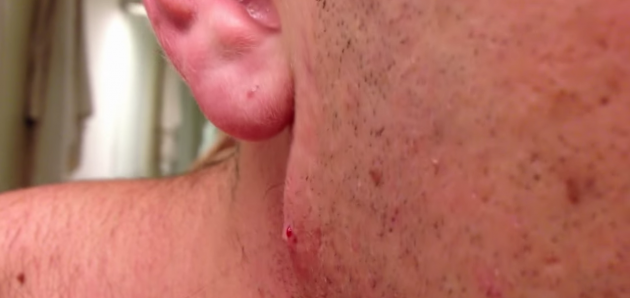 This Guy S Incredibly Long Ingrowing Hair Will Gross You Out Like