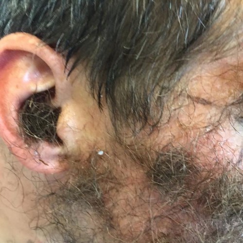 This man's mates glued their pubic hair to his face for a stag party