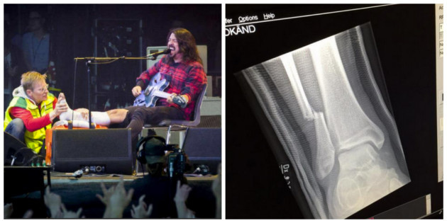 dave-grohl-leg-2-630x315