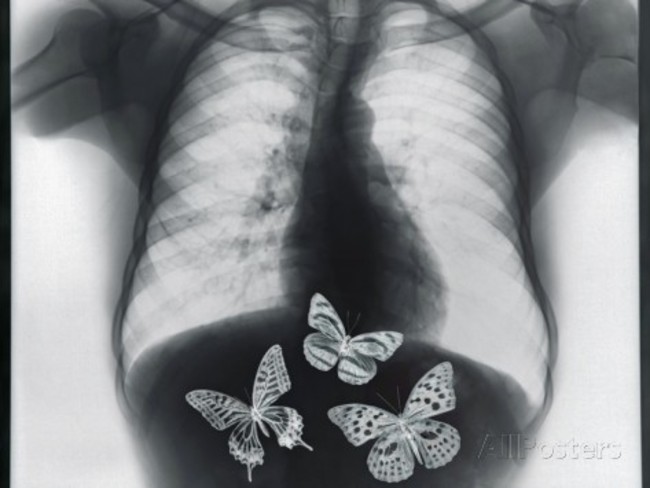 thom-lang-x-ray-of-butterflies-in-the-stomach