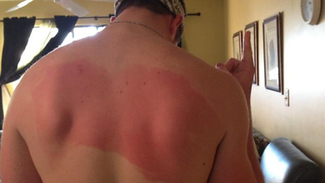 The forever alone sunburn