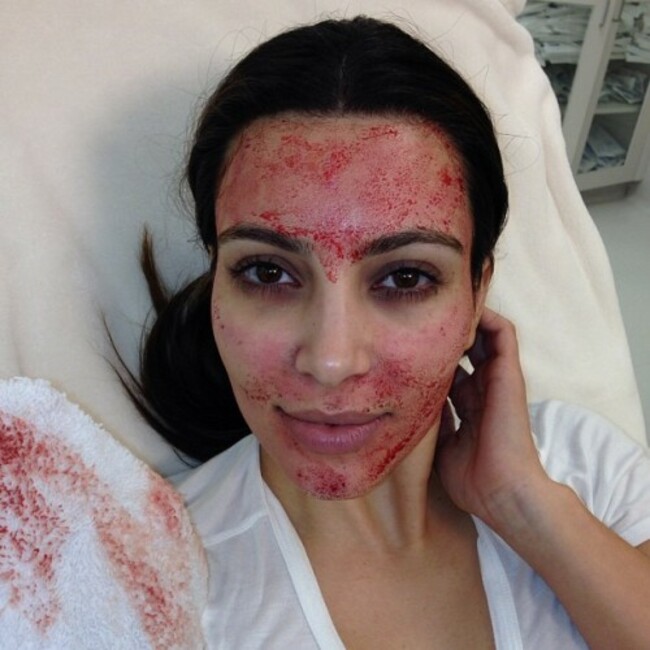 Tonight on Kourtney & Kim Take Miami!!! #VampireFacial #kktm