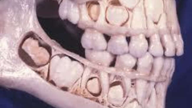A child's skull before losing baby teeth