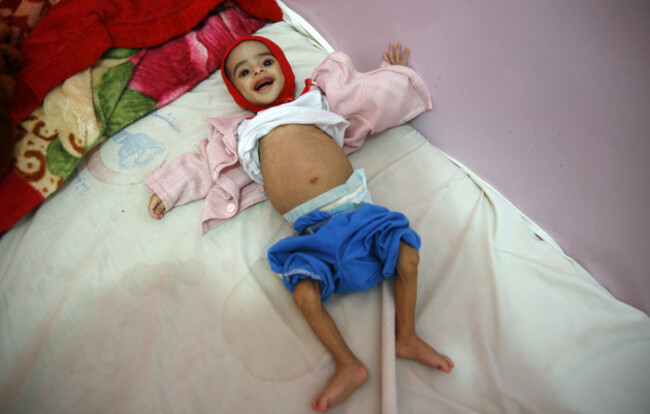 Yemen Hunger War