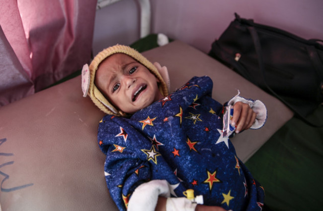 Children malnutrition in Yemen