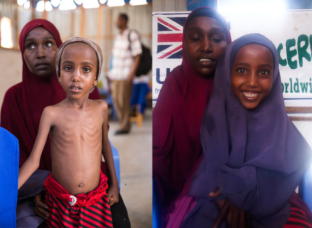 Yasmiin when arrived at Concern clinic on March 15 and 12 weeks later after treatment