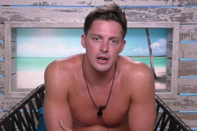 alex-sunburn-love-island