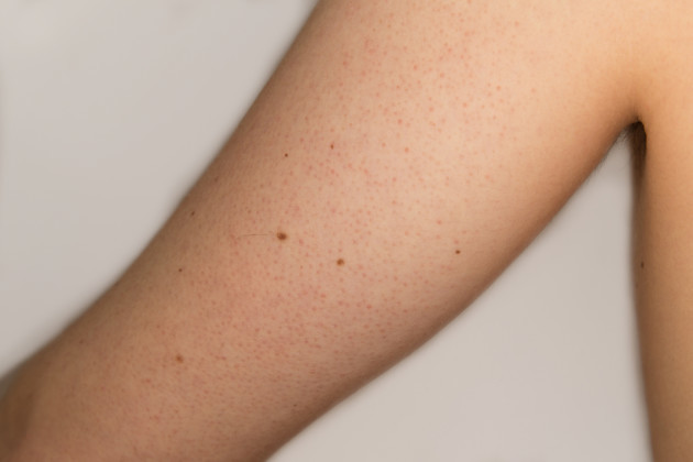 Keratosis Pilaris The Dos And Donts Of Caring For The Condition