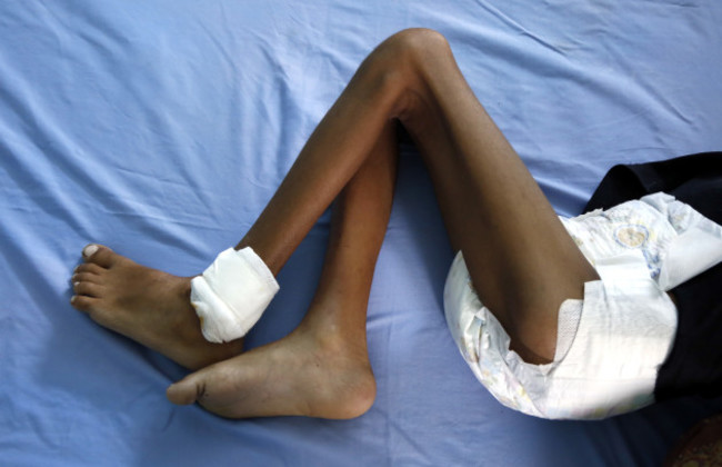 YEMEN-HODEIDAH-PATIENTS