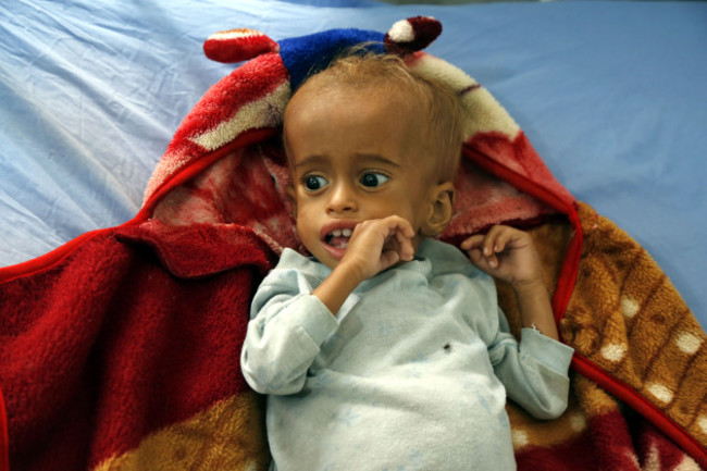 YEMEN-HODEIDAH-PATIENTS