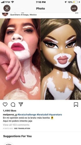 vitiligo bratz doll