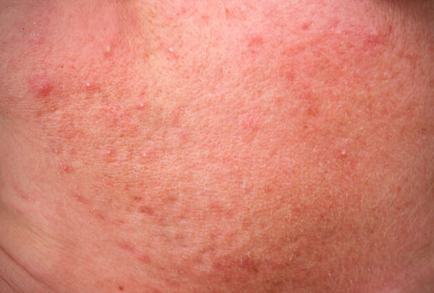 environ rosacea