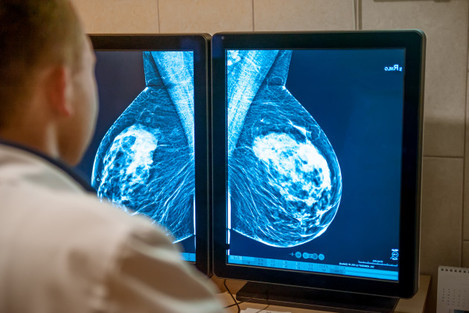 Concerning delays for mammograms as Dublin hospitals struggle to