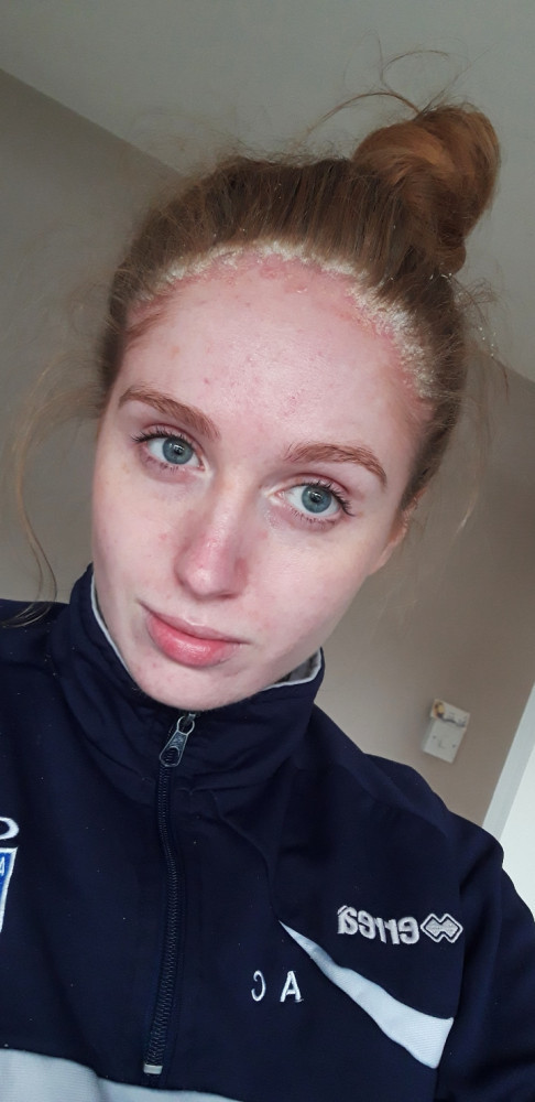 15. Zoe Ryan pictured with psoriasis presenting in the form of a halo on her forehead