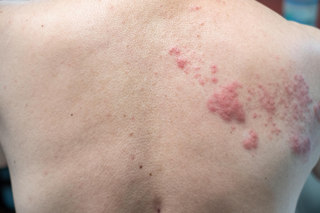 shingles-disease-herpes-zoster-varicella-zoster-virus-skin-rash-and-blisters-on-body