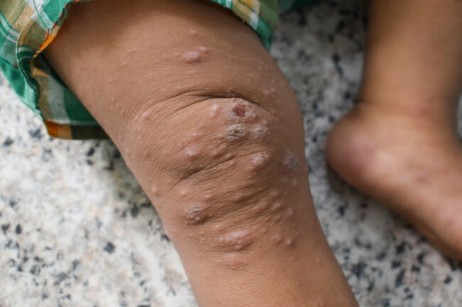 scabies-infestation-with-secondary-or-superimposed-bacterial-infection-and-pustules-in-leg-of-southeast-asian-burmese-child