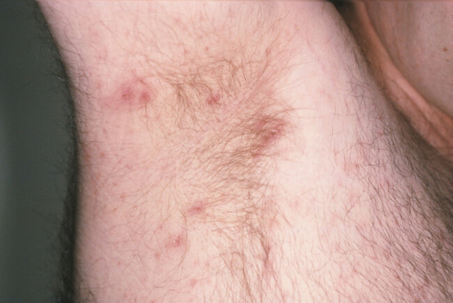 scabies