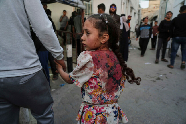 a-young-palestinian-girl-who-was-injured-in-an-israeli-airstrike-is-brought-for-a-treatment-at-the-baptist-hospital-in-gaza-city-on-thursday-april-3-2025-ap-photojehad-alshrafi