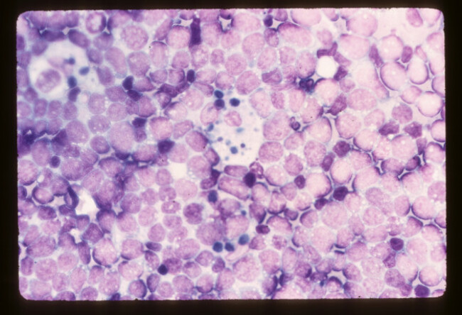 Burkitts lymphoma cells