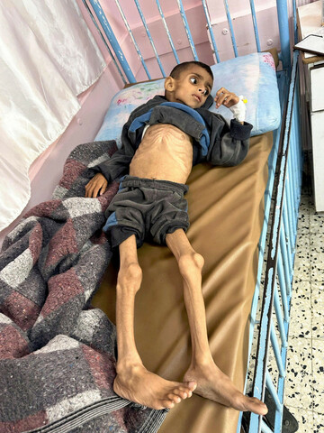 a-child-lies-malnourished-and-unable-to-absorb-food-in-a-hospital-in-khan-yunis-southern-gaza-palestinian-territories-on-april-26-2025-on-the-27th-israels-suspension-of-supplies-to-the-palestini