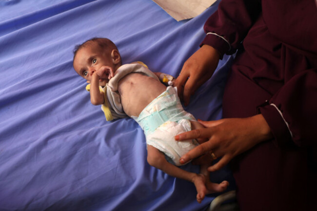 gaza-23rd-july-2025-a-palestinian-child-suffering-from-malnutrition-due-to-starvation-is-seen-at-al-rantisi-hospital-in-northern-gaza-city-on-july-23-2025-fifteen-more-people-including-four-chi