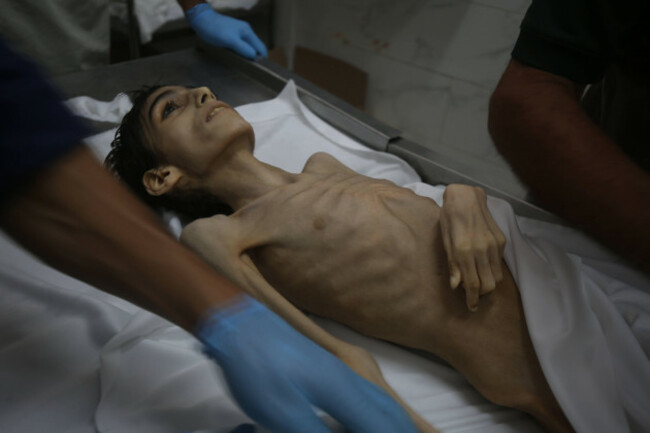 mahmoud-suhail-al-dabbeh-a-16-year-old-child-with-cerebral-palsy-in-gaza-city-gaza-died-due-to-malnutrition-under-israel-s-blockade-preventing-humanitarian-aid-mahmoud-suhail-al-dabbeh-a-16-year-o