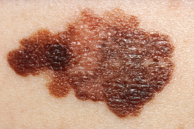 melanoma-skin-cancer