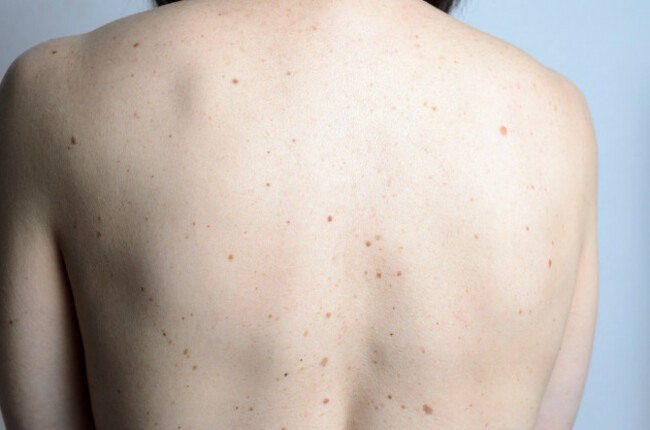 close-up-detail-of-the-bare-skin-on-a-womans-back-with-scattered-moles-and-freckles