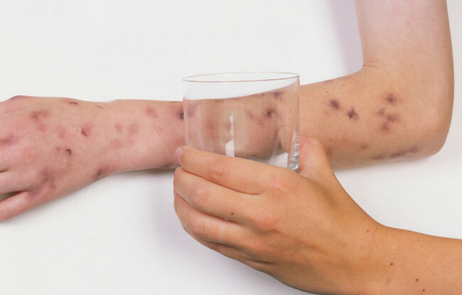 glass-held-on-childs-arm-covered-in-purple-rash-glass-test-for-meningitis-close-up