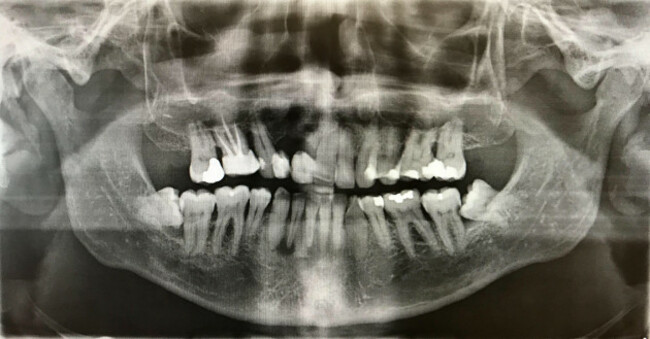 x-ray-photo-of-human-teeth-image-shot-122017-exact-date-unknown