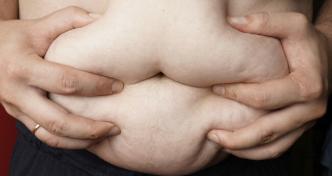 mans-hands-clutching-obese-gut-morbid-obesity-concept-need-for-diet