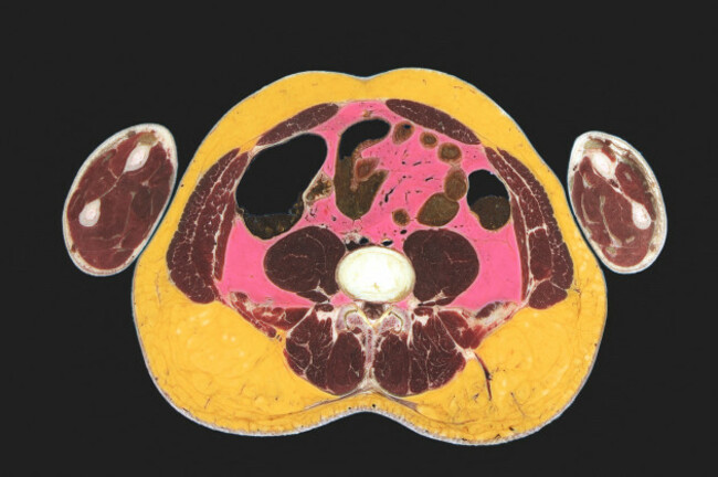cross-section-of-obese-human-showing-excess-fat