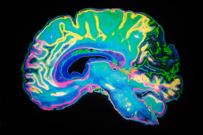 artificially-coloured-mri-scan-of-human-brain-image-shot-2009-exact-date-unknown