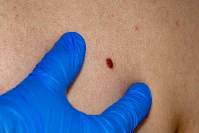 dermatologist-checking-the-size-of-benign-moles-on-the-back-of-a-young-man