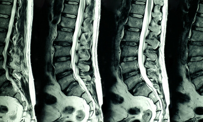 mri-scan-of-lumbar-spines-of-a-patient-with-chronic-back-pain-showing-degenerative-change-of-lumbar-spines-lumbar-disc-herniation-and-nerve-root-comp