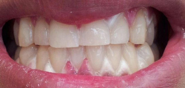 teeth gum disease whitening burn bad getting whitened heart thejournal ie children fancy know need diabetes sufferers risk