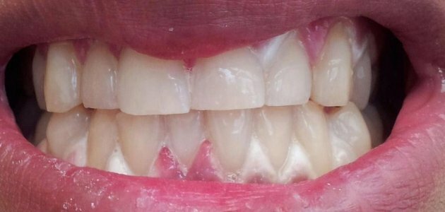 White gums around teeth after whitening